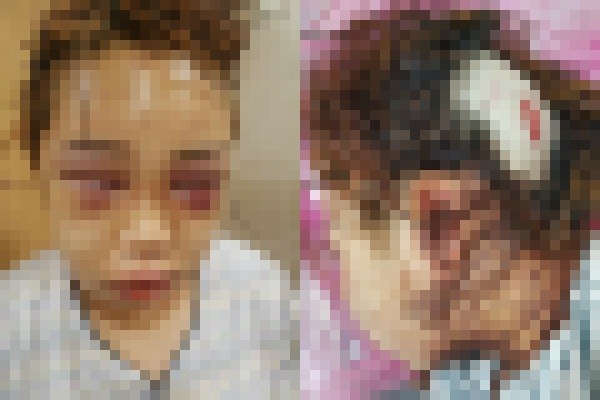 부산 여중생 폭행 사건의 피해 학생의 사진은 피해 학생의 어머니 경찰이 가벼운 부상이라고 피해 정도를 축소해 전한 것에 분노해 직접 SNS에 폭행당한 딸 얼굴 사진을 올리면서 퍼진 것으로 알려졌다. (사진출처=SNS)